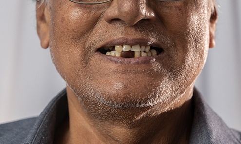 Up-close view of a man with multiple missing teeth