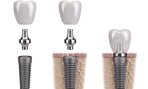 A CGI of dental implants