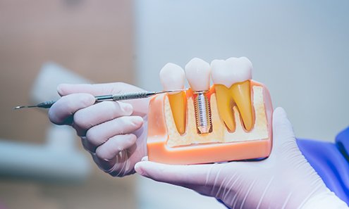 A model of dental implants