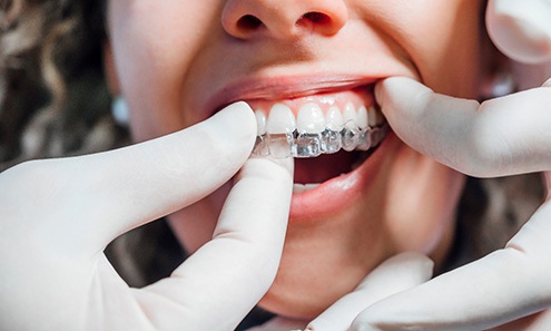 Dentist putting clear aligner on patient
